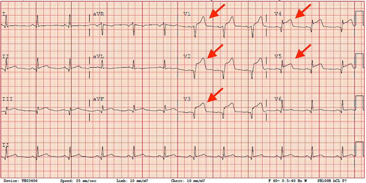 Cum recunoști un infarct miocardic pe EKG?